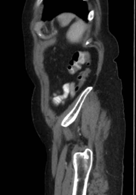 Appendicitis due to chicken fibula (Radiopaedia 74314-85198 C 91).jpg