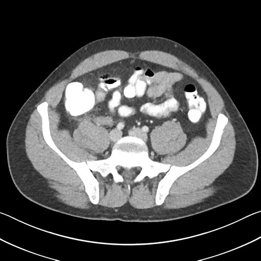 Appendicitis with cecal bar sign (Radiopaedia 31878-32830 B 57).jpg