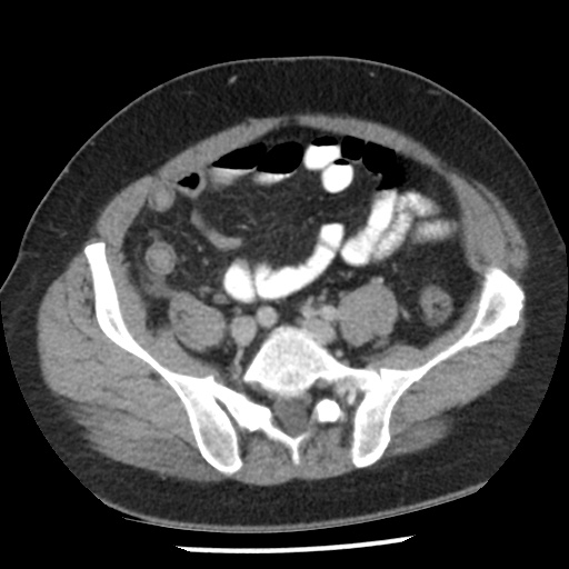 Appendicitis with perforation (Radiopaedia 35790-37342 A 37).jpg