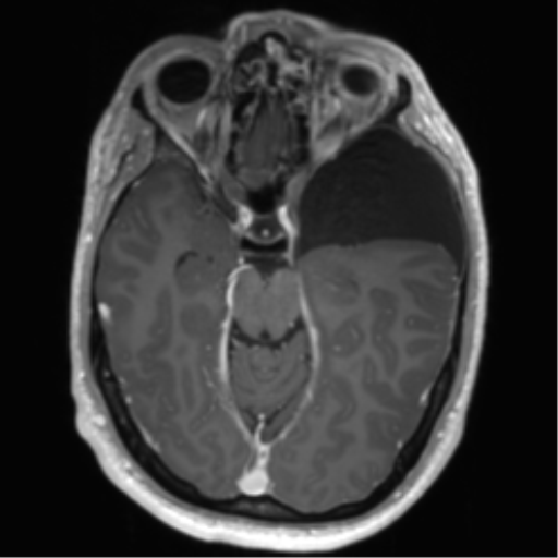 Arachnoid cyst with subdural hematoma (Radiopaedia 85892-101743 Axial T1 C+ 35).png