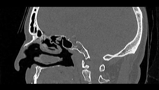 Arcuate foramen (Radiopaedia 89833-106944 Sagittal bone window 43).jpg