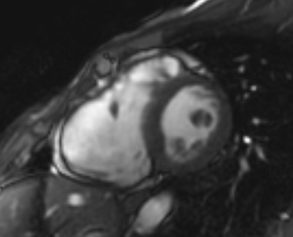 Arrhythmogenic right ventricular cardiomyopathy (Radiopaedia 69564-79464 short axis cine 148).jpg