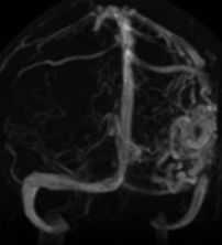 File:Arteriovenous malformation - cerebral (Radiopaedia 15901-15546 MRV 1).jpg
