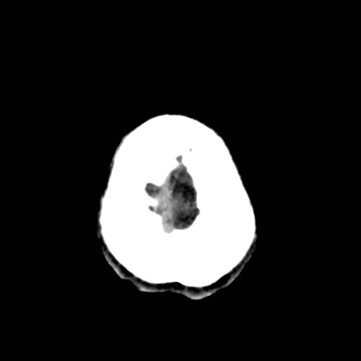 File:Artery of Percheron infarct (Radiopaedia 48088-52893 Axial non-contrast 37).jpg
