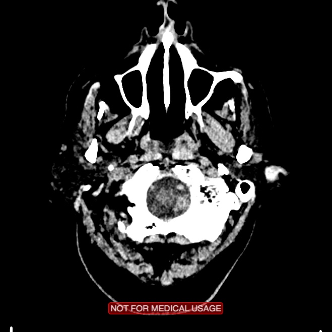 Artery of Percheron infarction (Radiopaedia 28679-28967 Axial non-contrast 7).jpg