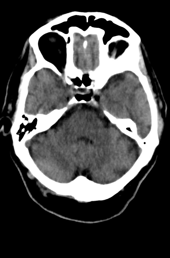 Artery of Percheron infarction (Radiopaedia 80613-94202 Axial non-contrast 60).jpg