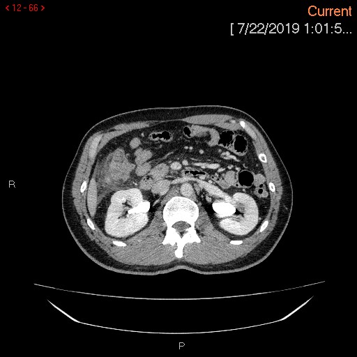 Ascending colonic diverticulum mimicking acute appendicitis (Radiopaedia 69943-80198 A 66).jpg