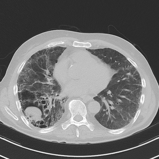 File:Aspergilloma on background pulmonary fibrosis (Radiopaedia 60942-68757 A 35).jpg
