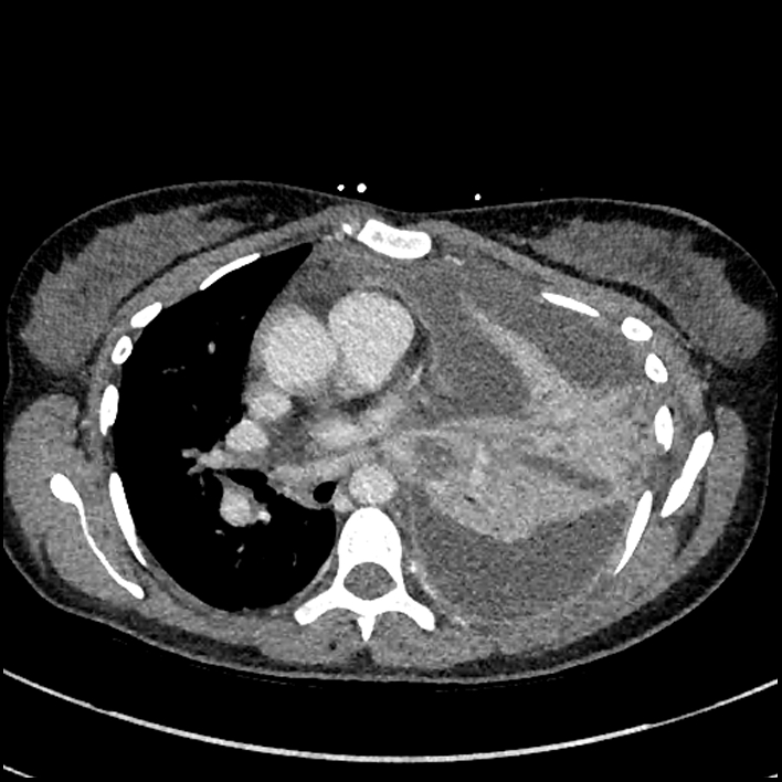 Aspiration pneumonia complicated by empyema (Radiopaedia 73024-83767 B 168).jpg
