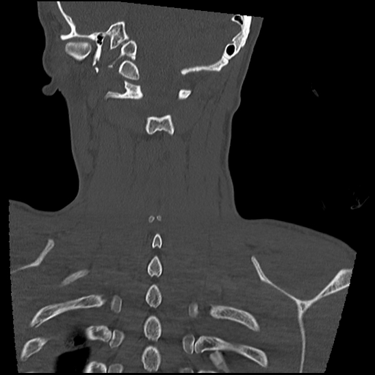 Atlanto-occipital dissociation (Traynelis type 1), C2 teardrop fracture, C6-7 facet joint dislocation (Radiopaedia 87655-104061 Coronal bone window 53).jpg