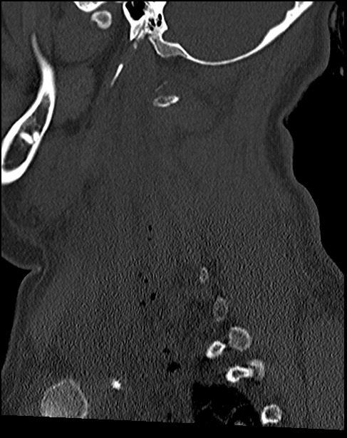 Atlanto-occipital dissociation - Traynelis type 1 (Radiopaedia 87570-103948 Sagittal bone window 61).jpg