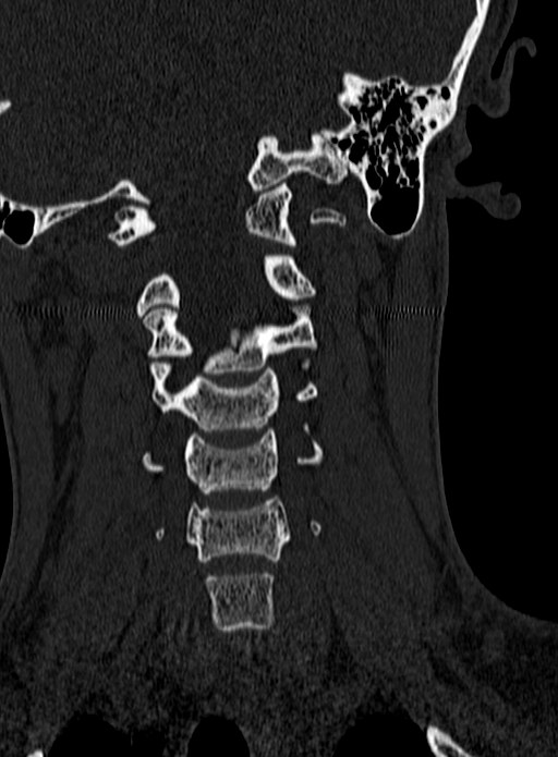 Atlantoaxial subluxation (Radiopaedia 44681-48450 Coronal bone window 58).jpg