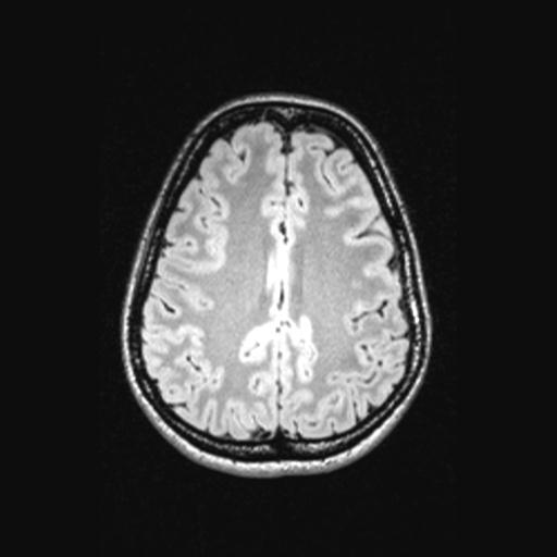 Atretic encephalocoele with inferior vermis hypoplasia (Radiopaedia 30443-31108 Axial 113).jpg