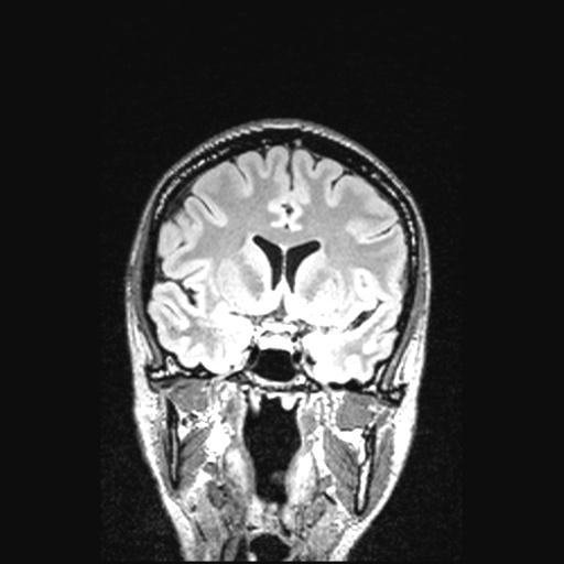 Atretic encephalocoele with inferior vermis hypoplasia (Radiopaedia 30443-31108 Coronal FLAIR 114).jpg