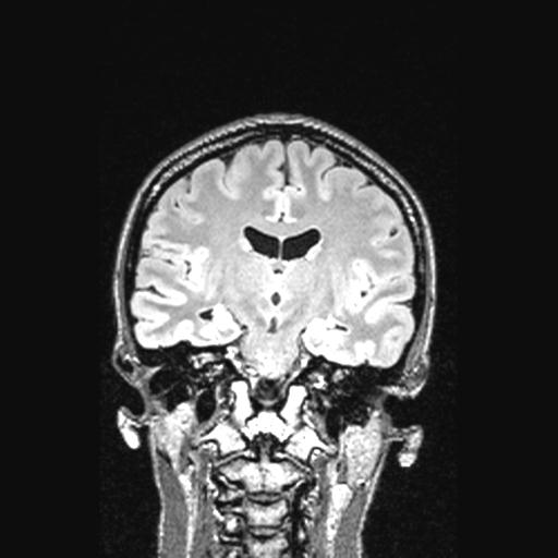 Atretic encephalocoele with inferior vermis hypoplasia (Radiopaedia 30443-31108 Coronal FLAIR 93).jpg