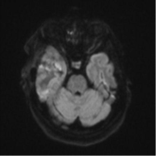 Atypical meningioma (WHO Grade II) (Radiopaedia 54742-60981 Axial DWI 37).png