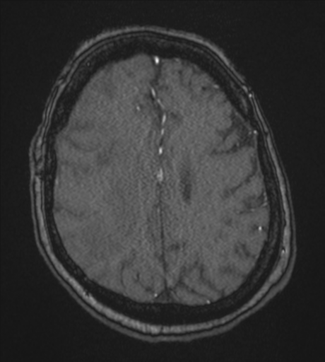 Atypical meningioma (WHO Grade II) (Radiopaedia 54742-60981 Axial MRA 71).png