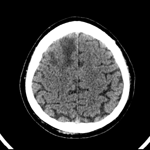 File:Atypical meningioma (WHO grade II) with brain invasion (Radiopaedia 57767-64728 Axial non-contrast 35).png