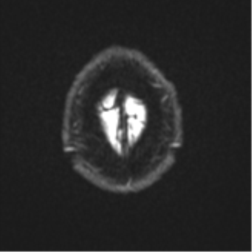 File:Atypical meningioma (WHO grade II) with brain invasion (Radiopaedia 57767-64729 Axial DWI 29).png