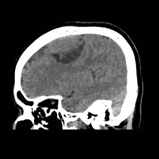 Atypical meningioma (WHO grade II) with osseous invasion (Radiopaedia 53654-59715 C 16).png