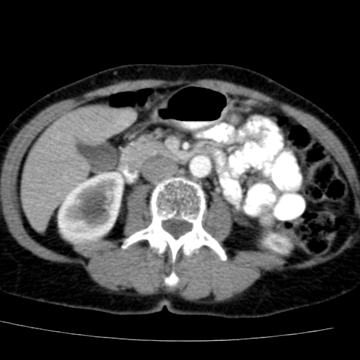 File:Atypical renal cyst (Radiopaedia 17536-17251 renal cortical phase 21).jpg