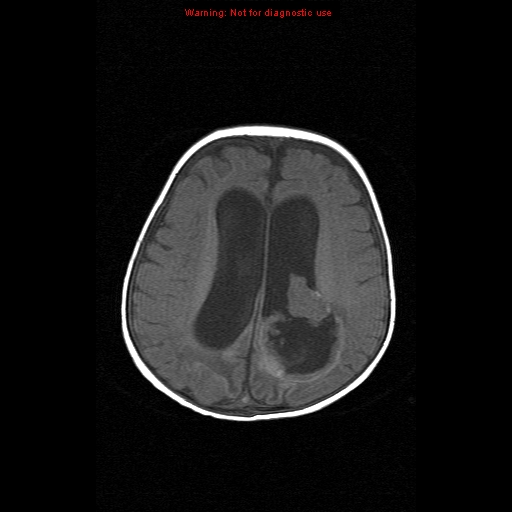 File:Atypical teratoid rhabdoid tumor (Radiopaedia 10712-11183 Axial T1 6).jpg