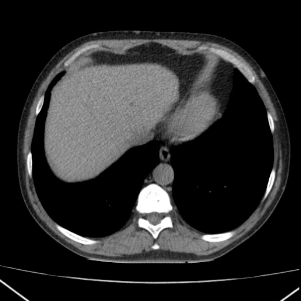 File:Autosomal dominant polycystic kidney disease (Radiopaedia 36539-38101 Axial non-contrast 9).jpg
