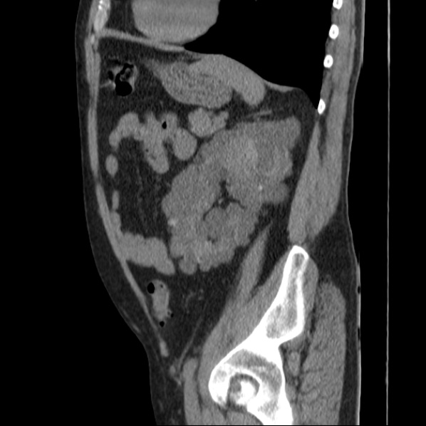 Autosomal dominant polycystic kidney disease (Radiopaedia 36539-38101 D 59).jpg