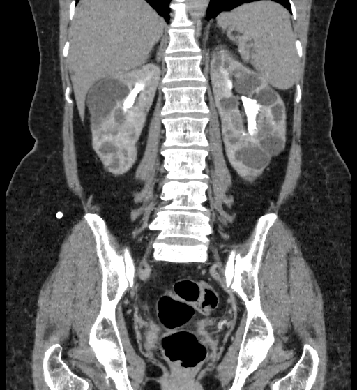File:Autosomal dominant polycystic kidney disease (Radiopaedia 38189-40194 Coronal C+ delayed 68).jpg