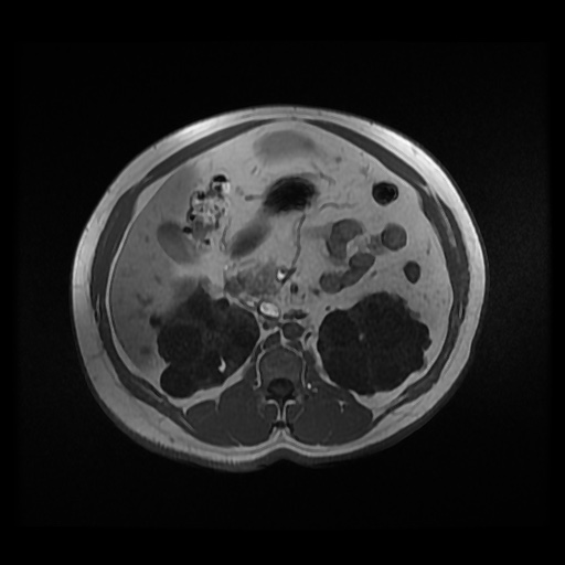 Autosomal dominant polycystic kidney disease (Radiopaedia 50259-55611 Axial 2D Dual Echo 42).jpg