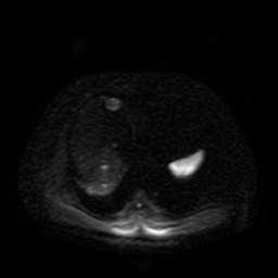 Autosomal dominant polycystic kidney disease (Radiopaedia 50259-55611 Axial DWI 41).jpg