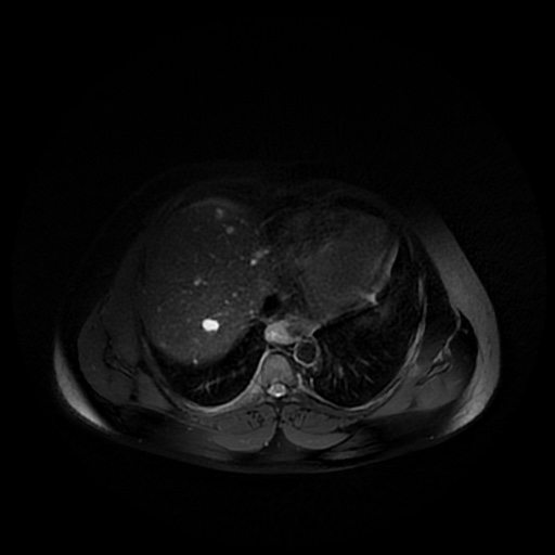 File:Autosomal dominant polycystic kidney disease (Radiopaedia 50259-55611 Axial T2 fat sat 4).jpg