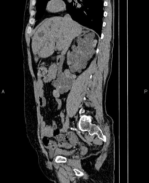 Autosomal dominant polycystic kidney disease (Radiopaedia 87830-104287 C 33).jpg