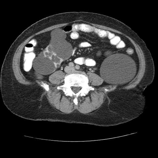 Autosomal dominant polycystic kidney disease with hepatic involvement (Radiopaedia 32693-33662 C 52).jpg