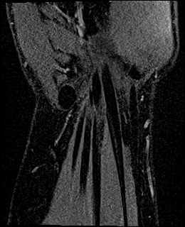 Avascular necrosis of the capitate (Radiopaedia 88317-104948 Coronal T1 vibe 74).jpg