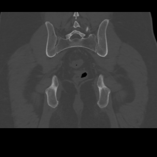 File:Avascular necrosis of the hip (Radiopaedia 61503-69467 Coronal bone window 31).jpg
