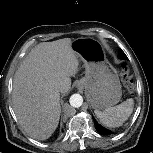 File:Azygos continuation of the inferior vena cava (Radiopaedia 18537-18404 C+ arterial phase 49).jpg