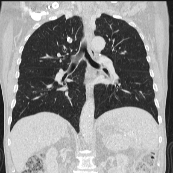Azygos lobe (Radiopaedia 38259-40275 Coronal lung window 47).jpg