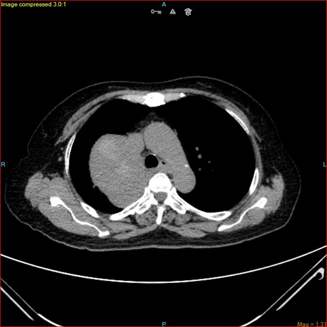 Azygos vein aneurysm (Radiopaedia 77824-90130 A 21).jpg