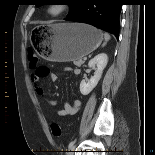Bariatric balloon causing gastric outlet obstruction (Radiopaedia 54449-60672 C 26).jpg
