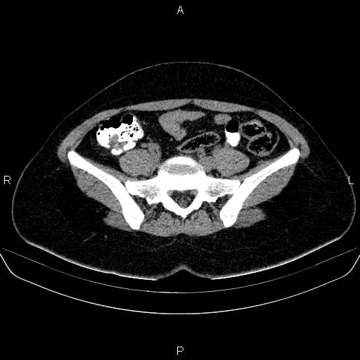Bartholin gland cyst (Radiopaedia 62635-70930 Axial non-contrast 16).jpg