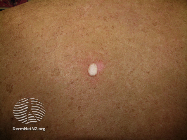 File:Basal cell carcinoma affecting the trunk (DermNet NZ lesions-bcc-trunk-0694).jpg