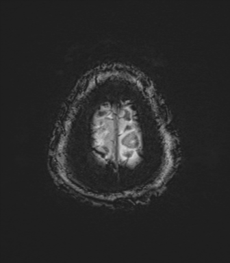 Basal ganglia metastasis (Radiopaedia 78928-91828 Axial SWI 85).png