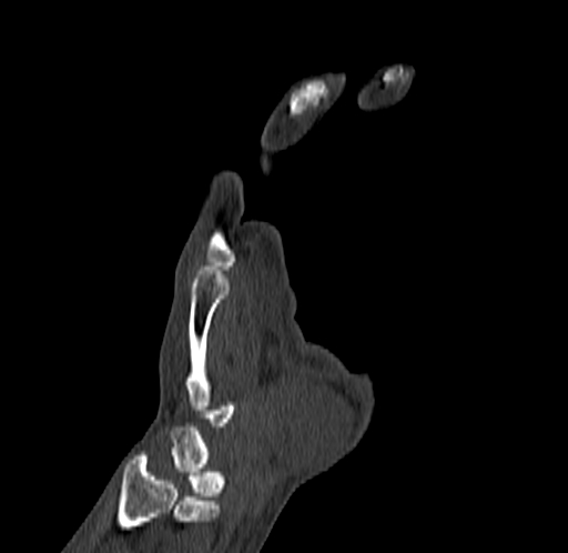 Base of 2nd metacarpal fracture (Radiopaedia 73741-84544 Coronal bone window 29).jpg