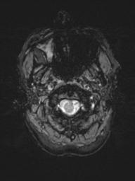 Base of skull chondrosarcoma (Radiopaedia 30410-31070 Axial SWI 3).jpg
