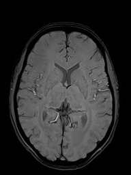 Basilar artery perforator aneurysm (Radiopaedia 82455-97733 Axial SWI 30).jpg
