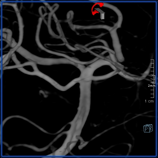 Basilar artery perforator aneurysm (Radiopaedia 82455-99524 3D Left VA 80).jpg