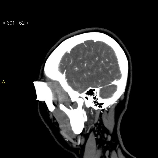 File:Basilar artery thrombosis (Radiopaedia 16260-15944 C 56).jpg