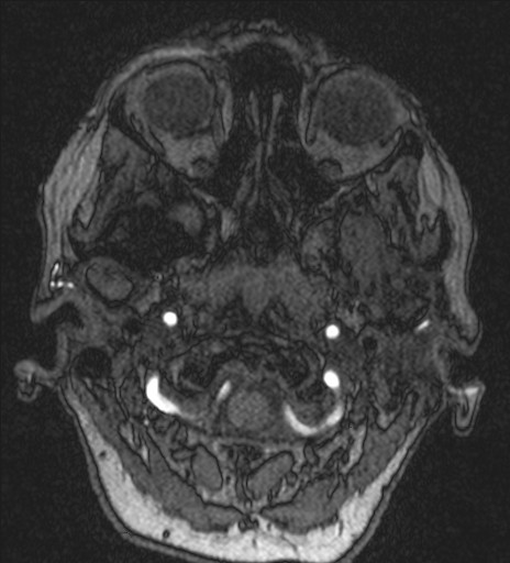 Basilar tip aneurysm (Radiopaedia 26504-26632 MRA 14).jpg