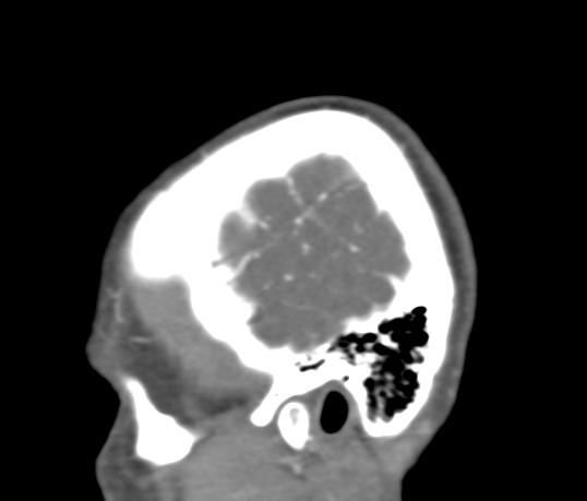 File:Basilar tip aneurysm with coiling (Radiopaedia 53912-60086 C 7).jpg